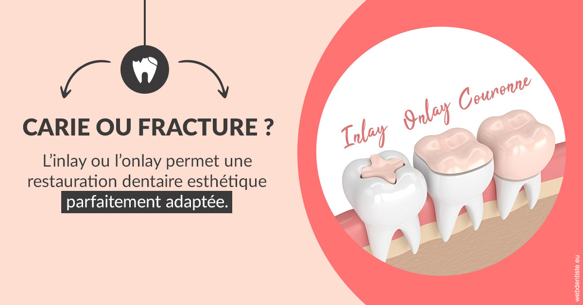 https://www.dr-magrou-limoux-dentiste.fr/T2 2023 - Carie ou fracture 2