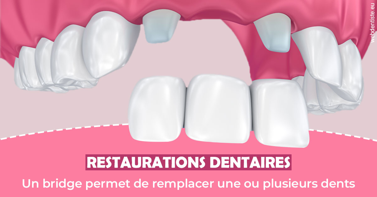 https://www.dr-magrou-limoux-dentiste.fr/Bridge remplacer dents 2
