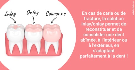 https://www.dr-magrou-limoux-dentiste.fr/L'INLAY ou l'ONLAY 2