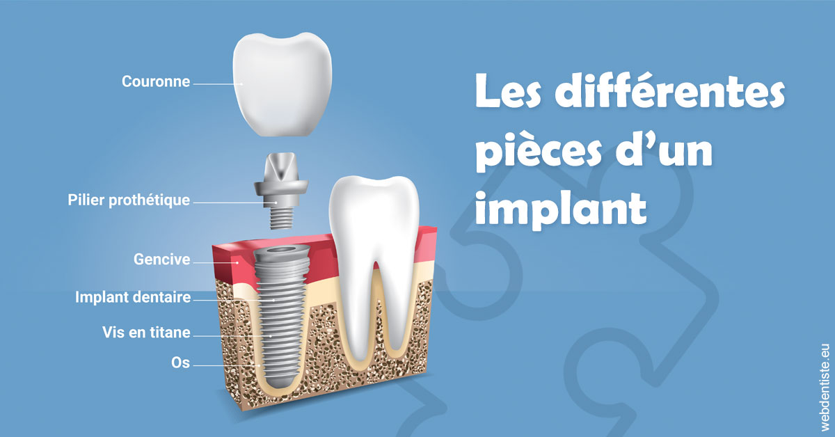 https://www.dr-magrou-limoux-dentiste.fr/Les différentes pièces d’un implant 1